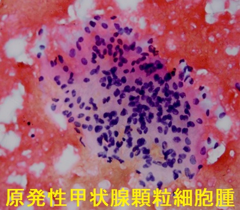 甲状腺顆粒細胞腫 細胞診