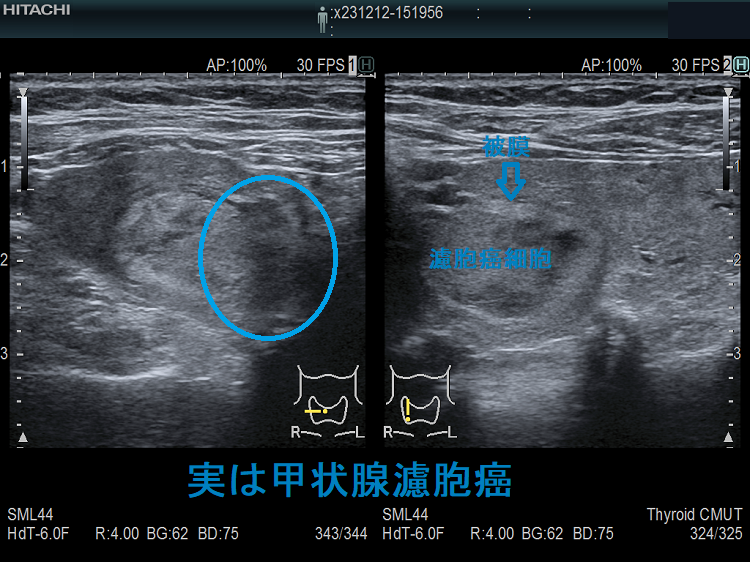 実は甲状腺濾胞癌 被膜を越えて周囲へ浸潤 実は甲状腺濾胞癌 被膜を越えて周囲へ浸潤
