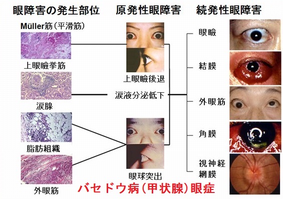 突出 バセドウ 病 眼球 目の異変はバセドウ病のサイン！？その原因や治療法は？ Vol.1