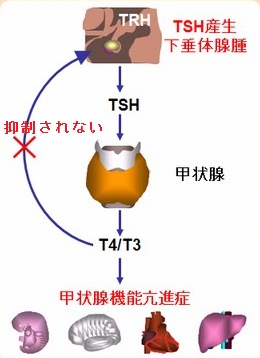 TSH産生下垂体腫瘍の原因