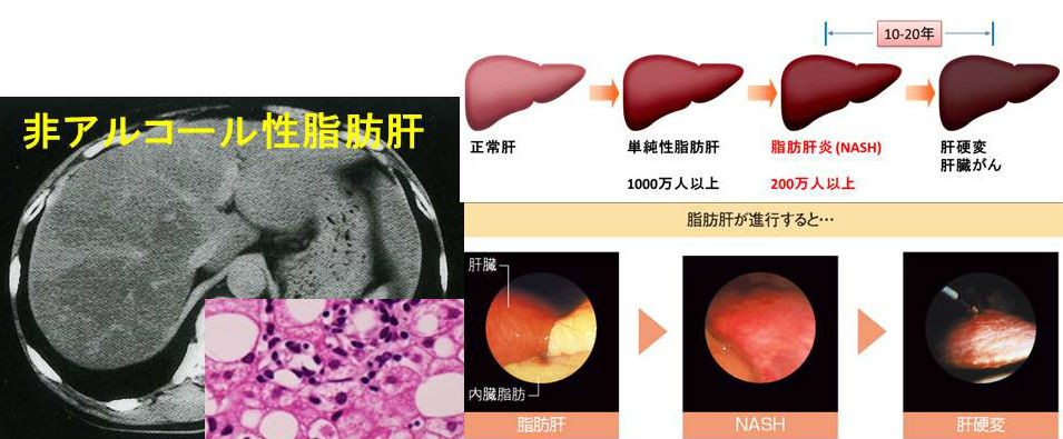 甲状腺・糖尿病と非アルコール性脂肪性肝疾患（NAFLD）と非アルコール性脂肪肝炎（NASH） [橋本病 バセドウ病 動脈硬化 長崎甲状腺クリニック(大阪)]