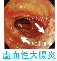 血性 腸炎 虚