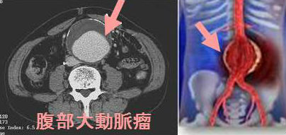 腹部大動脈瘤（トリプルA）