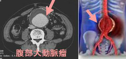 上 腸 間 膜 動脈 症候群