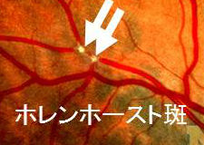 網膜動脈の黄色斑（ホレンホースト斑）