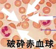 血栓性血小板減少性紫斑病（TTP）