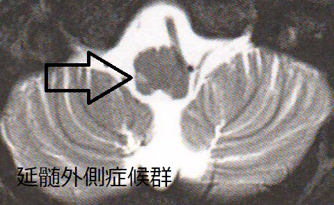 Wallenberg症候群　MRI画像