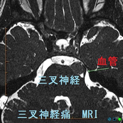 三叉神経痛　MRI