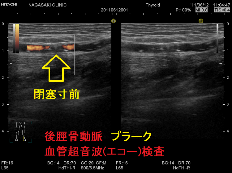 後脛骨動脈 プラーク 血管超音波(エコー)検査