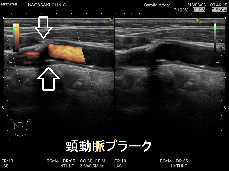 頸動脈プラーク 超音波(エコー)画像