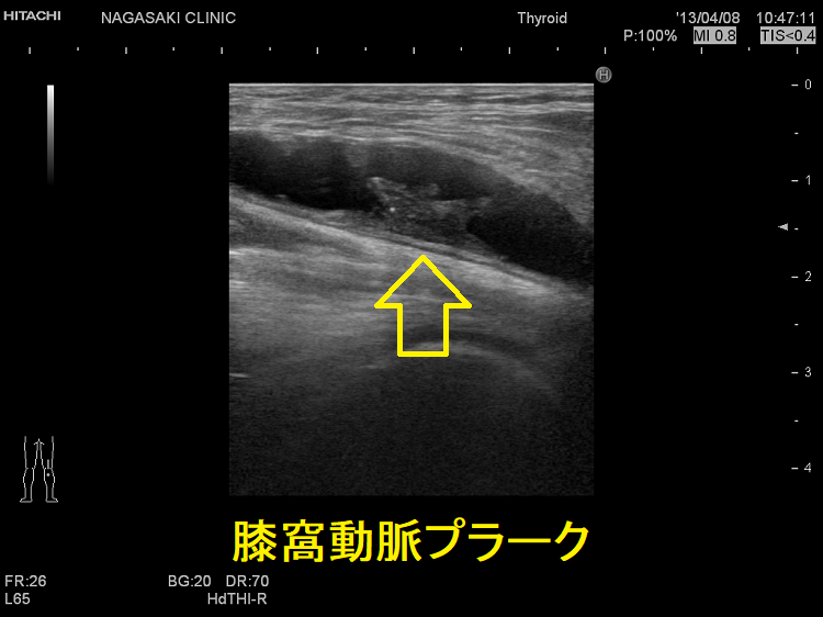 膝窩動脈プラーク 超音波(エコー)画像