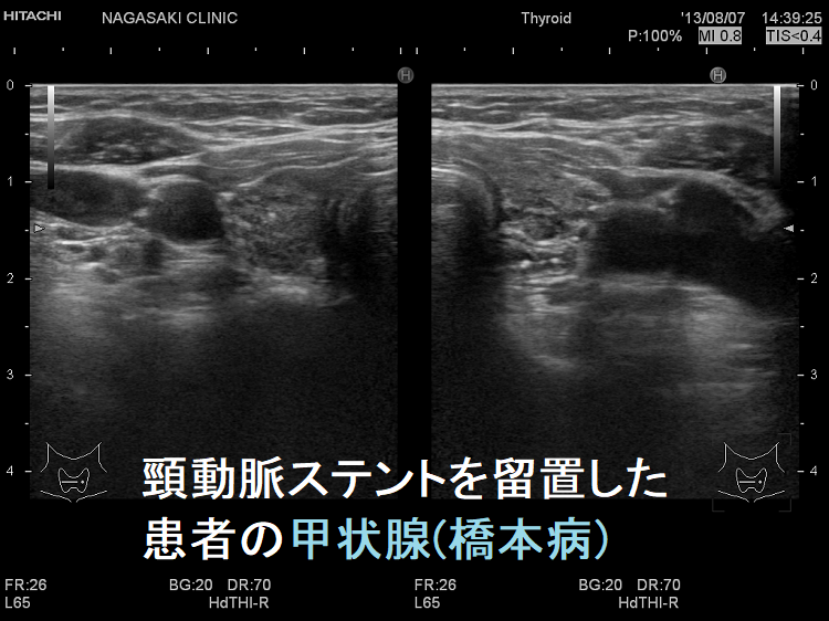 頸動脈ステントを留置した患者の甲状腺 超音波(エコー)画像