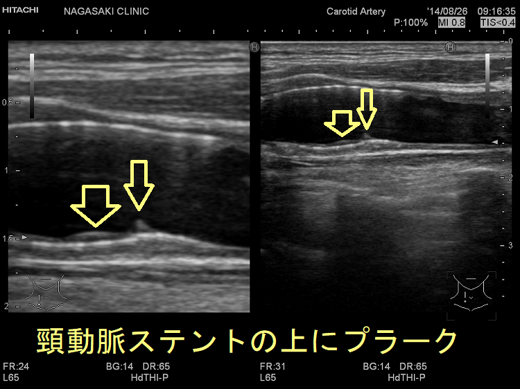 頸動脈ステントの上にプラーク 超音波(エコー)画像