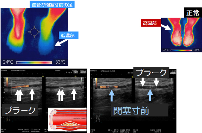 サーモグラフィーと血管超音波(エコー)検査