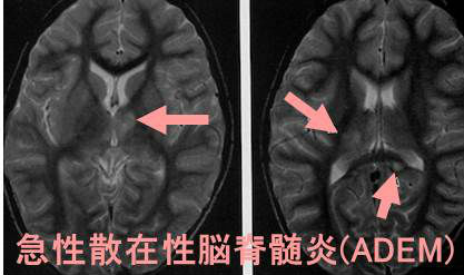 急性散在性脳脊髄炎(ADEM：acute disseminated encephalomyelitis)