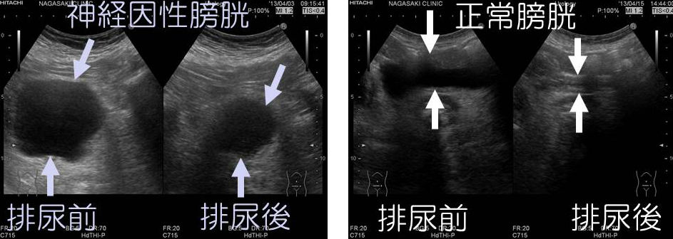 膀胱 は と 性 因 神経 【解答・解説】両側水腎症の原因を探る！｜実践！画像診断Q&A｜羊土社：レジデントノート ｜実践！画像診断Q&A｜羊土社：レジデントノート