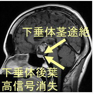 中枢性尿崩症(ADH 分泌不全)MRI画像