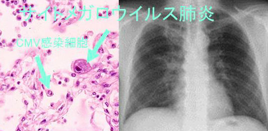 甲状腺 糖尿病とウイルス 免疫不全 甲状腺 専門医 橋本病 バセドウ病 長崎甲状腺クリニック大阪