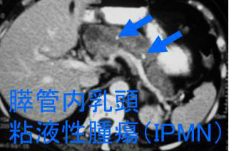 膵管内乳頭粘液性腫瘍（IPMN）
