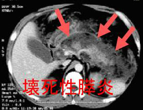 急性壊死性膵炎　造影CT画像