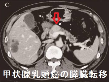 甲状腺乳頭癌の膵臓転移　造影CT