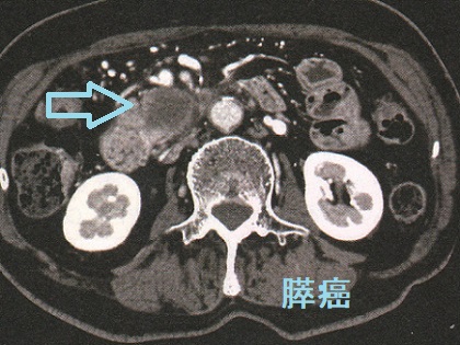 膵癌　造影CT画像