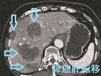 膵癌肝転移　造影CT画像