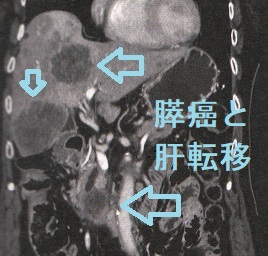 膵癌肝転移　造影CT画像