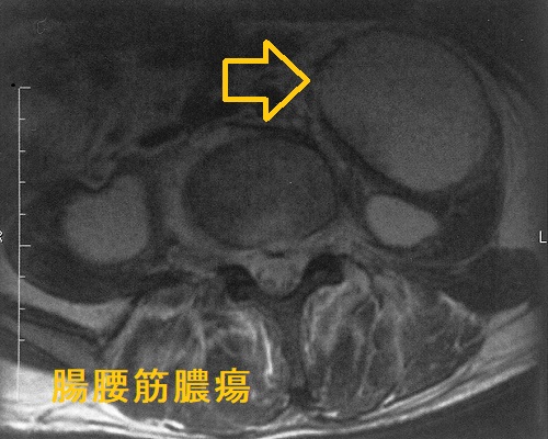 腸腰筋膿瘍 腰椎MRI T2強調画像