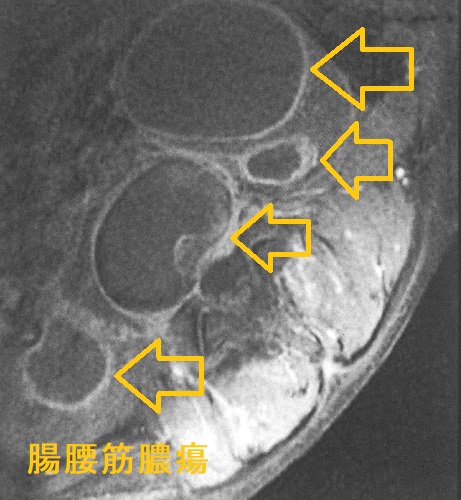 腸腰筋膿瘍 腰椎造影MRI画像