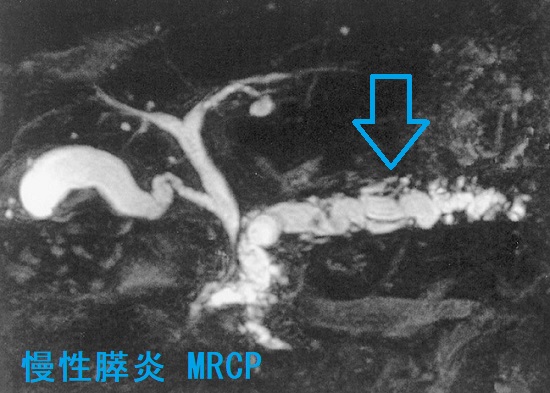 慢性膵炎 MRCP