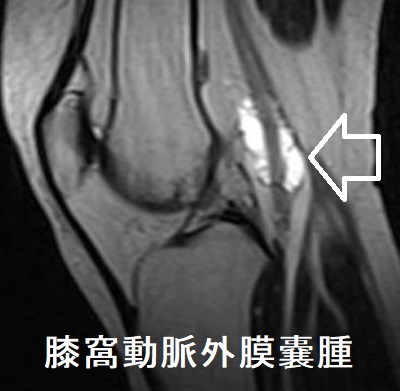 膝窩動脈外膜嚢腫 MRI T2WI画像