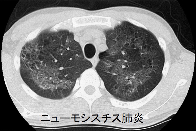ニューモシスチス肺炎 肺CT画像