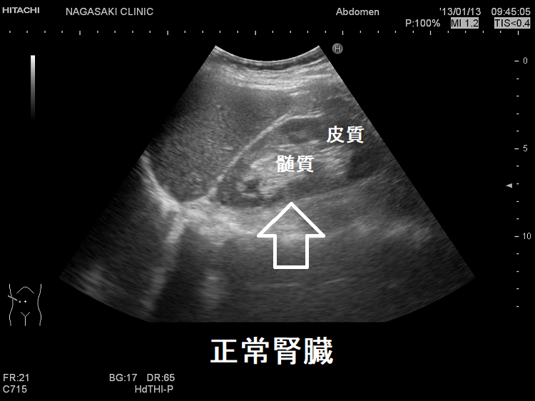 正常腎臓 超音波(エコー)画像