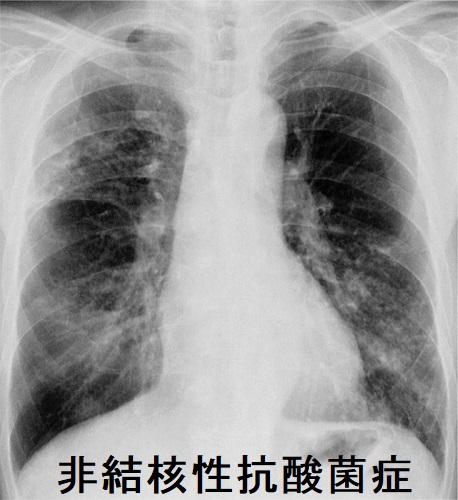 非結核性抗酸菌症 胸部X線