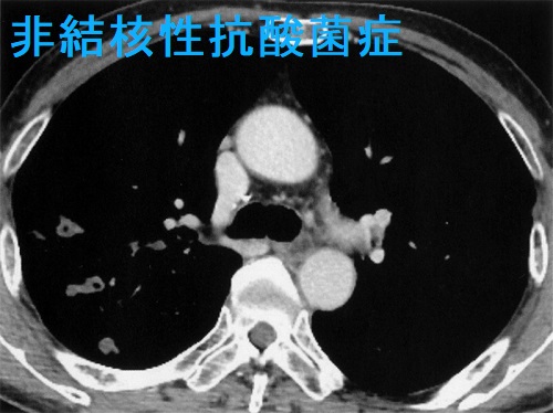 非結核性抗酸菌症 胸部CT 2