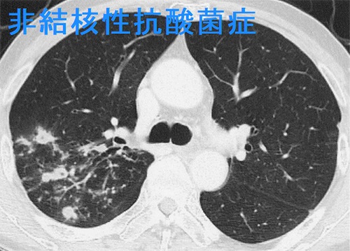 非結核性抗酸菌症 胸部CT