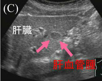 肝血管腫 肝細胞癌 肝膿瘍と甲状腺 甲状腺専門医 橋本病 バセドウ病 長崎甲状腺クリニック 大阪