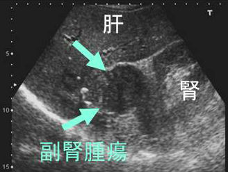 転移性副腎腫瘍・ 副腎皮質癌・ 副腎原発悪性リンパ腫[日本甲状腺学会認定 甲状腺専門医 橋本病 バセドウ病 甲状腺エコー 長崎甲状腺クリニック(大阪)]