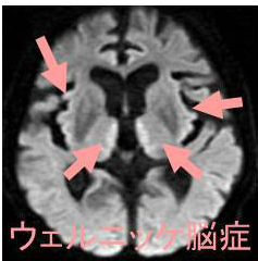 脳症 ウェルニッケ