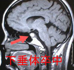 下垂体卒中 MRI画像