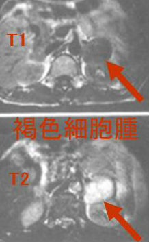 副腎腫瘍(褐色細胞腫) MRI画像