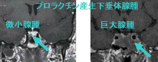 プロラクチノーマ（下垂体ダイナミックMRI）