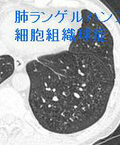 肺ランゲルハンス細胞組織球症（肺好酸球性肉芽腫症）