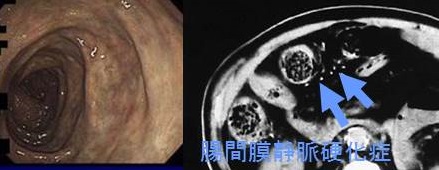 腸 間 膜 静脈 硬化 症