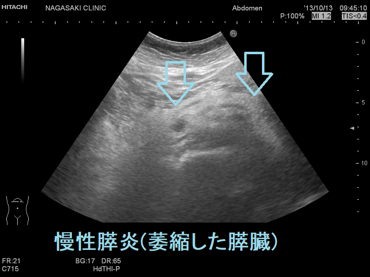 慢性膵炎(萎縮した膵臓) 超音波エコー画像
