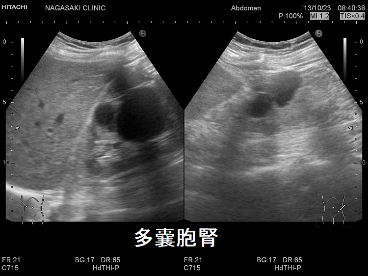 多発性嚢胞腎(ADPKD) 超音波エコー画像