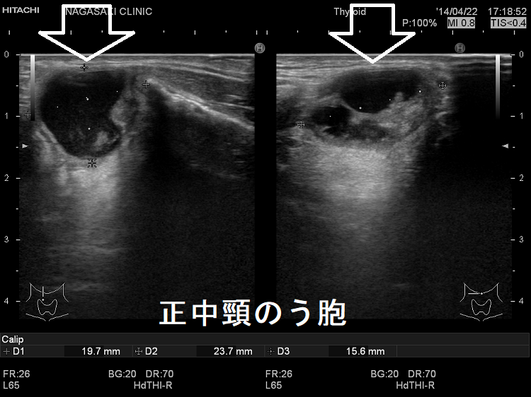 正中頸のう胞 超音波（エコー）画像