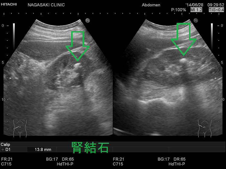 腎結石 超音波(エコー)画像2