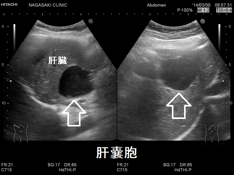 肝嚢胞 超音波エコー画像